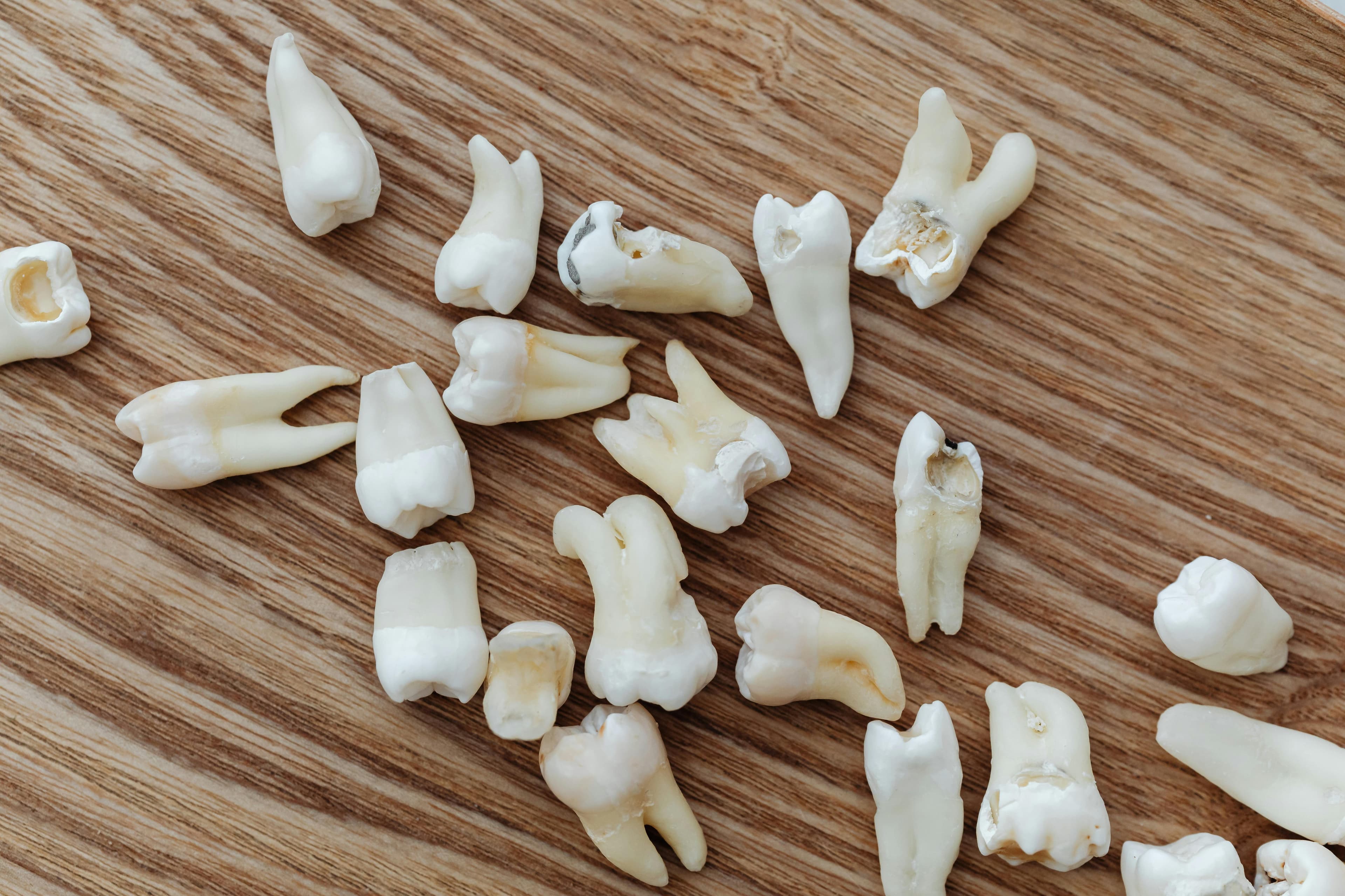 Wisdom Tooth Removal